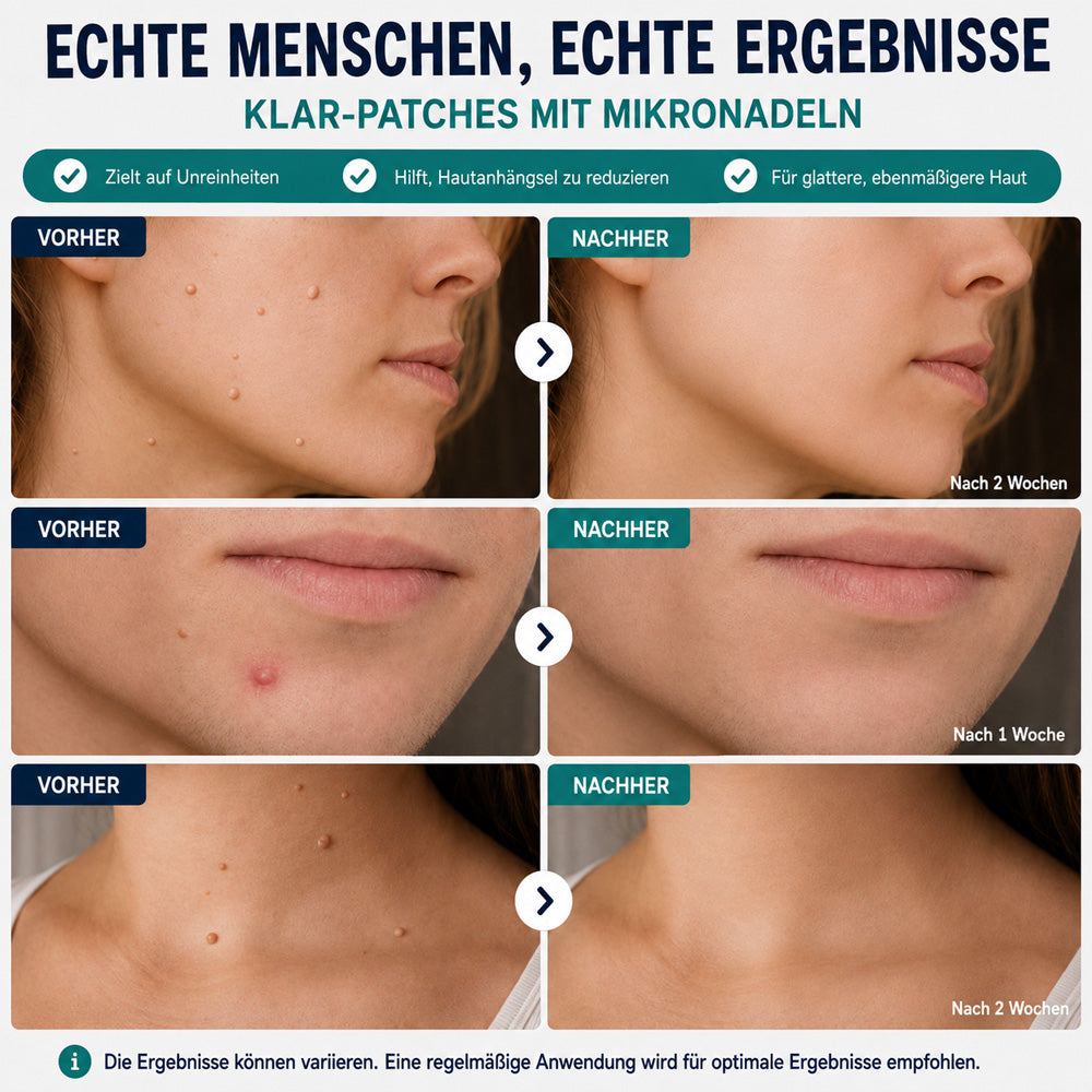 Effektive botanische Mikronadel-Pflaster zur Entfernung von Hautanhängseln