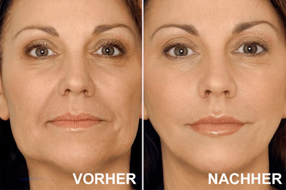 ✨ V-Face Lifting Tape🪄– Sofortiger Lift-Effekt & straffere Konturen