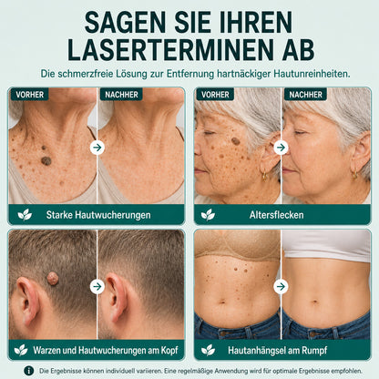Effektive botanische Mikronadel-Pflaster zur Entfernung von Hautanhängseln