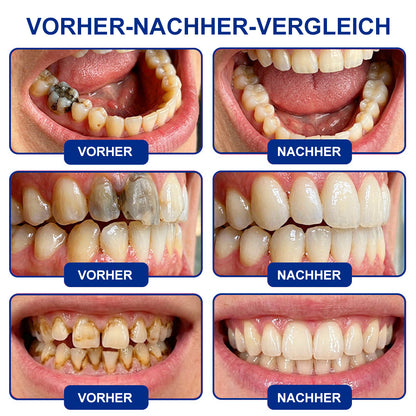 🤍Drefryna® Zahnschmelz-Reparatur Gel