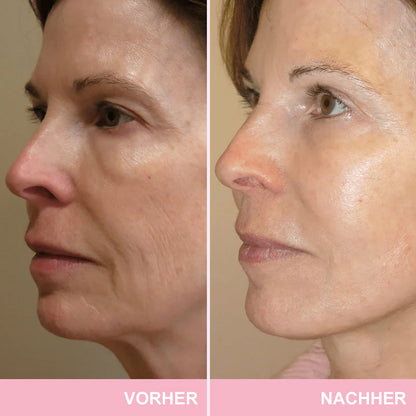✨ V-Face Lifting Tape🪄– Sofortiger Lift-Effekt & straffere Konturen