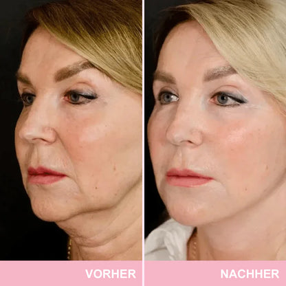 ✨ V-Face Lifting Tape🪄– Sofortiger Lift-Effekt & straffere Konturen