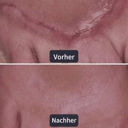 Avapalo® Advanced Silicone Scar Gel – Professional Scar Removal Cream for Surgical Scars, Keloids, Stretch Marks, C-Section & Old or New Scars Repair Treatment
